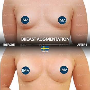 Breast Augmentation Before After Turkey