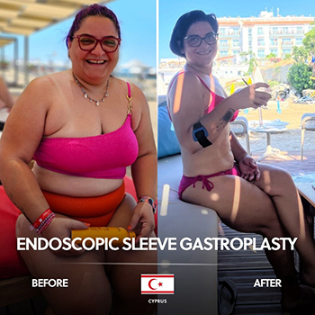 Endoscopic Sleeve Gastroplasty Before After