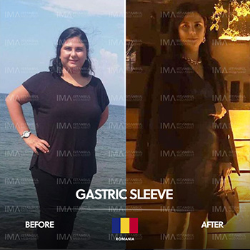 Gastric Sleeve Before After