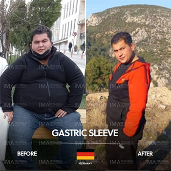 Gastric Sleeve Before After Turkey