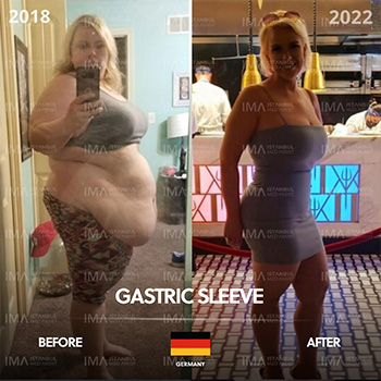 Gastric Sleeve Before After Price