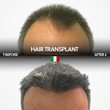 Haartransplantation Preis Türkei