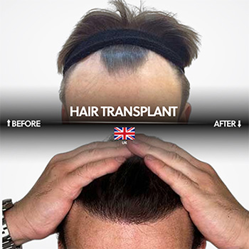 Hair Transplant Cost Turkey