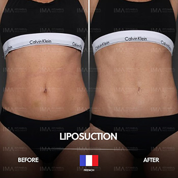 Liposuction Before After