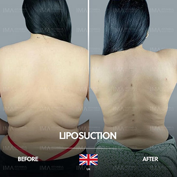 Liposuction Price Turkey