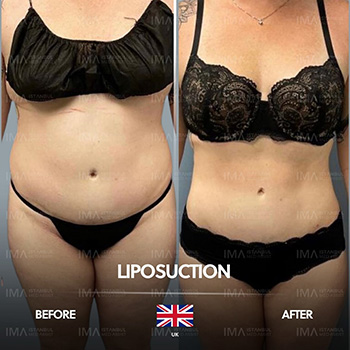 Liposuction Cost Turkey