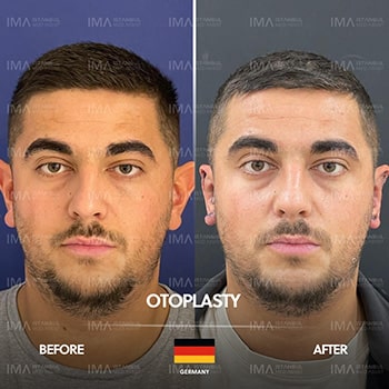 Otoplasty Surgery in Turkey