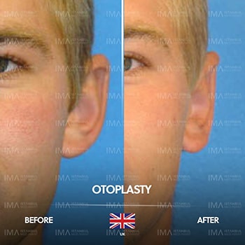 Otoplasty Surgery Cost