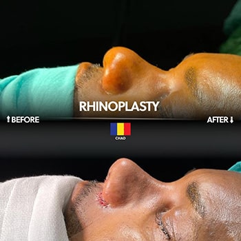 Chirurgie de rhinoplastie en Turquie