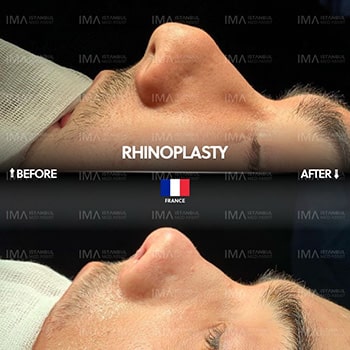 Coût de la chirurgie de Rhinoplastie