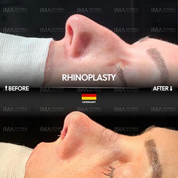 Rhinoplasty Surgery Price