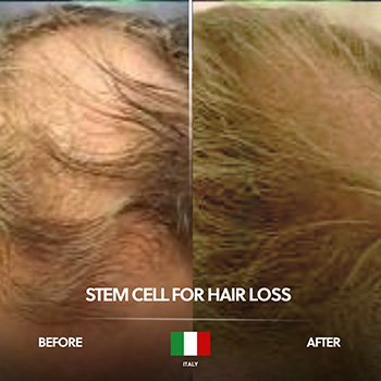 Stem Cell for Hair Loss Before After