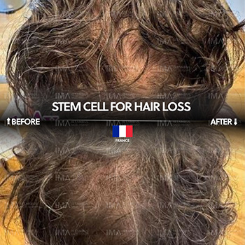 Stem Cell for Hair Loss Before After Turkey