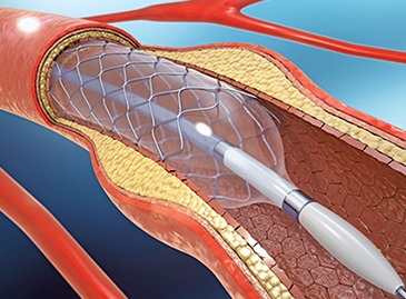 When is a coronary angioplasty required?