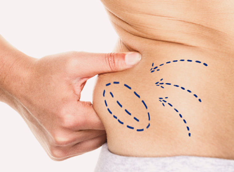 How long does it take to fully recover from liposuction?