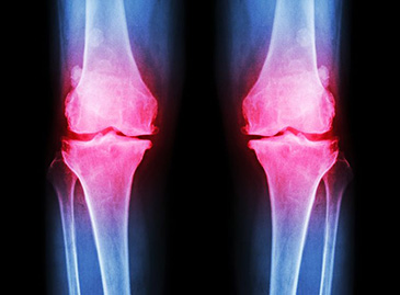 What is the Newest Treatment for Osteoarthritis?