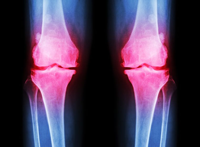 Was ist die neueste Behandlung für Osteoarthritis?