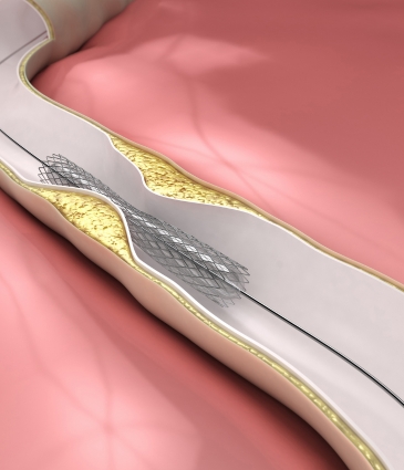 Coronary Angioplasty & Stenting Price Turkey