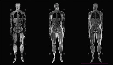 Whole Body MRI