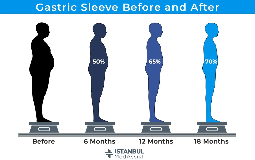 This picture shows how much you can expect to lose excess weight after this procedure.