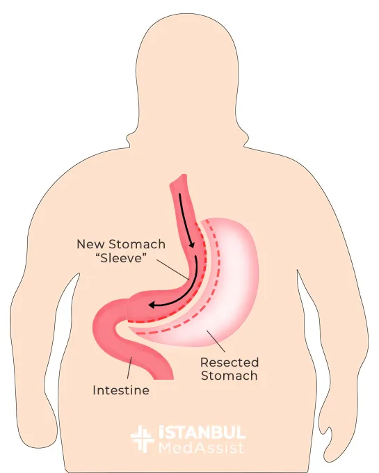 This graphic image shows what portion of the stomach is removed by the gastric sleeve.